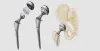 Optimal Recovery from Hip Fractures | Tips to Recover Fast From Hip Fractures