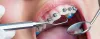 Orthodontic Dental Braces Treatments | Dental Clips in Coimbatore