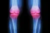 Ayurvedic &amp; Panchakarma treatment for Osteoarthritis |