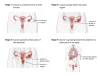 DIAGNOSIS AND TESTS OF OVARIAN CANCER