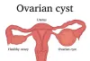 Natural Treatment for Ovarian Cyst - Causes, Types, Symptoms &amp; Health Tips |