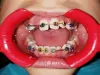  What Is The Need To Fix An Overbite At The Early Age | invisalignnearme