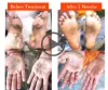 Palmar Psoriasis Treatment a Journey to Success -Astang Ayurveda