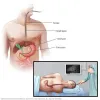 Benefits and Disadvantages Of Pancreatic Cancer