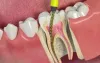 Root Canal: Purpose, Procedure, and Risks