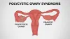 Polycystic Ovarian Syndrome Ayurvedic and Panchkarma Treatment  |