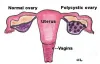 What is PCOS? Know the Best Treatment Cost &amp; Clinic in Delhi, India