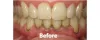 Gum Treatment in Mumbai | Dental Crown | Teeth Crown | Royal Implant
