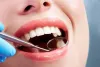 What are the different stages of Periodontitis?  |  Urbndental