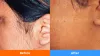 Laser Hair Removal Pune - Karishma Cosmetic