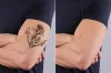Best Laser Tattoo Removal in Dubai &amp; Abu Dhabi | Royal Clinic Dubai