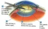 Cataract treatment in Mumbai | Cataract Surgery In India