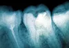 Best Dental Implant Surgeon Bellevue - Dental Implants Bellevue, WA