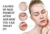 pigmentation treatment