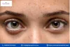 pigmentation eyes