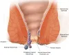 Ayurvedic &amp; Panchakarma Treatment for Piles (Hemorrhoids) |