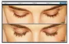 LATISSE solution With Dr. Leo Ayzenberg MD Eye retinopathy System in Chicago