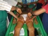 Rheumatoid Arthritis Treatment in Ayurveda with Panchakarma