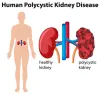 Can Ayurveda Treat PKD Naturally?