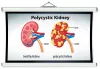 How To Treat Polycystic Kidney Disease?