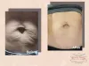 Stretchmarks Removal | Stretchmarks Treatment - Beauty Recipe Aesthetics &amp; Academy