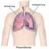 Book Pneumothorax Treatment in Gurgaon, India Call Now