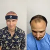 Hair Restoration Center in Aventura, FL | American Mane Hair Restoration