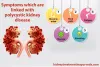 Symptoms Which are Linked with Polycystic Kidney Disease
