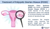 PCOD Treatment