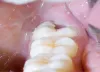 Management of Pericoronitis using Dental Diode Laser
