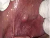 Excision of Mucocele Using Dental DIODE LASER