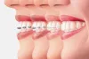 Ask the Dentist: How Young is too Young for Braces? &bull; Yoursmile.sg