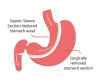 BARIATRIC Surgery Perth | Best OBESITY and WEIGHT Loss Surgeon