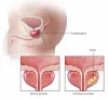 Best Oncologist For Prostate Cancer 
