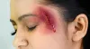 Prosthetic Stitch Marks
