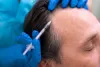 PRP Hair Treatment In Roorkee - Hair Treatment -