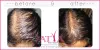 PRP for Hair Loss / regrowth in Delhi - Satya Hair Clinic