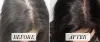  Best Hair Treatment in Malviya Nagar, South Delhi - Dr. Hiranmayi Jha