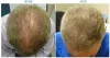 PRP Treatment For Hair loss