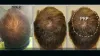PRP Hair Transplant in Tirupati | Hair Loss Treatment in Tirupati