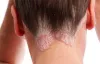 Psoriasis treatment in Greater kailash