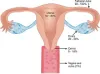How Does Tuberculosis Affect Female Fertility?