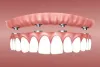 Are dental implants any good?