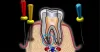 Root Canal Treatment in Coimbatore, Race Course, Ramanathapuram