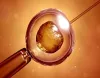 IVF treatment in India