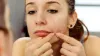 Hormonal Acne and Its Treatment
