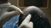 Hair Transplant : Permanent Solution to Your Hair Loss