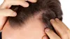 Hair Transplant on Scar: Yes It Works, Here's How