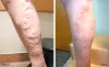 Removal Of Varicose Veins In Legs