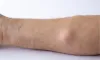 Lipoma Treatment In Dubai - Dr Daniel Serralta